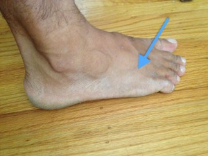 Top of the Foot Pain